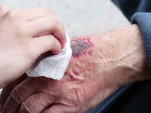 MOST COMMON INJURY IN SPORTS